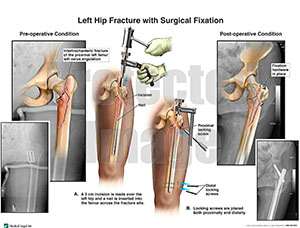 Left Hip Fracture Surgical Fixation